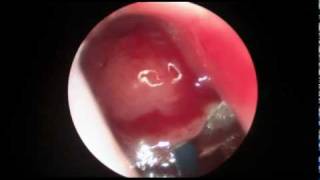Adenoidectomy Video (HD)