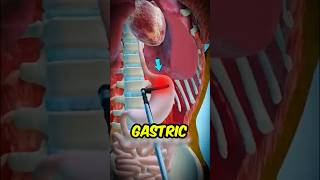 If You Ever Wondered How Gastric Surgery Actually Works..😳