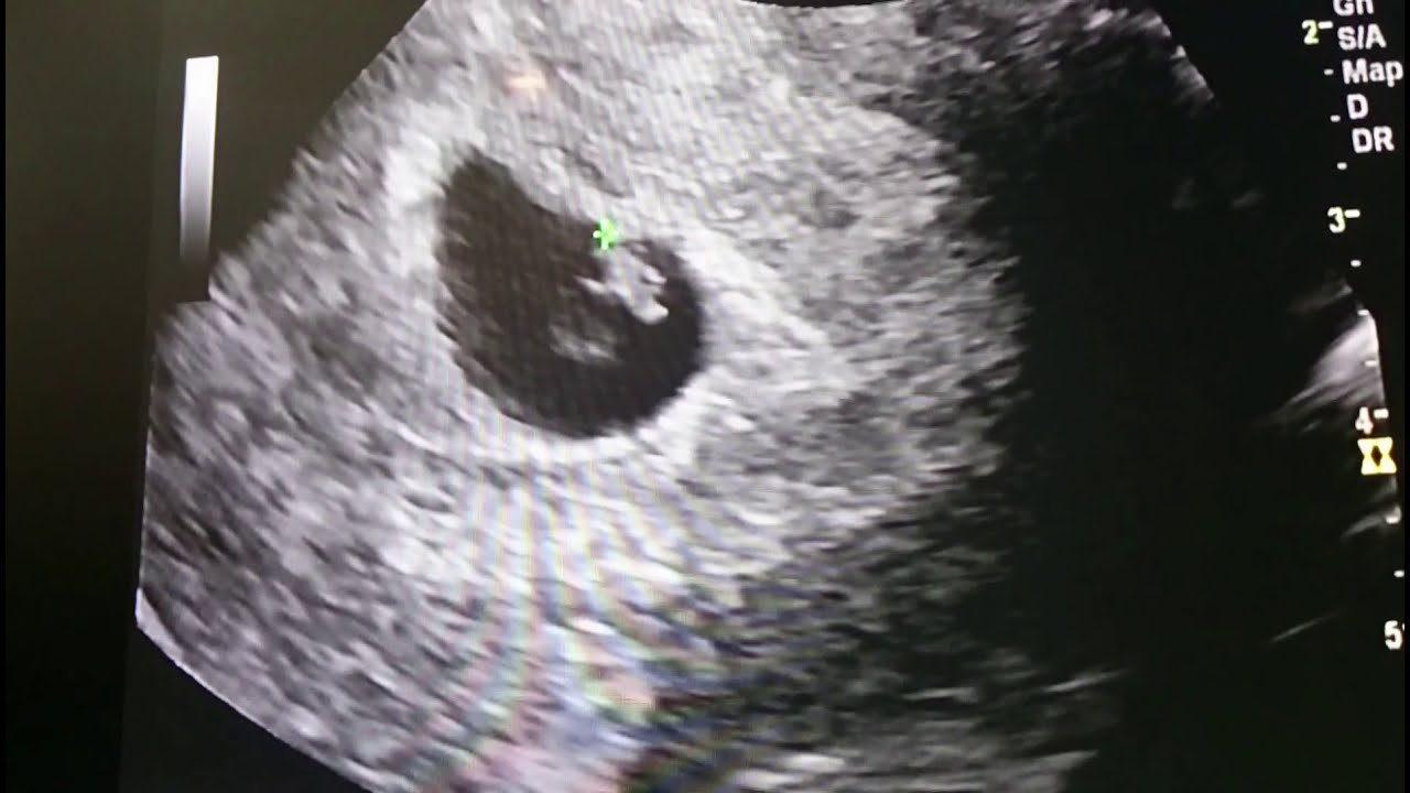 6 weeks pregnant trans vaginal ultrasound (first pregnancy) - YouTube