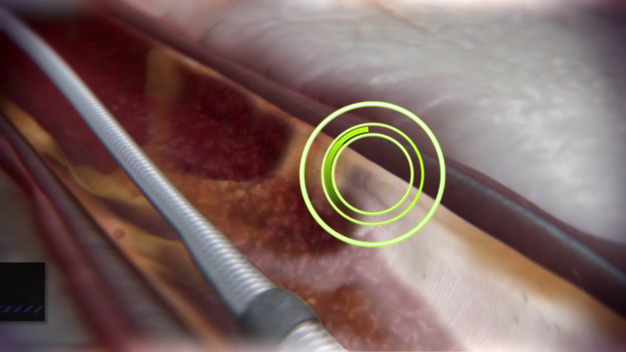 Coronary Orbital Atherectomy (Long video) - YouTube