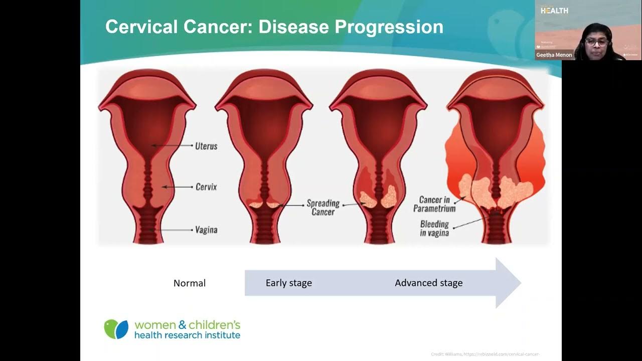 Side Effects Of Radiation Treatment For Cervical Cancer