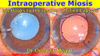 Tips for using Iris Hooks in a case of Intraoperative Miosis, & Calcified Capsule - Dr Deepak Megur