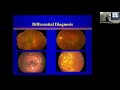 Lecture: Retinal Vein Occlusion: Dr David Miller