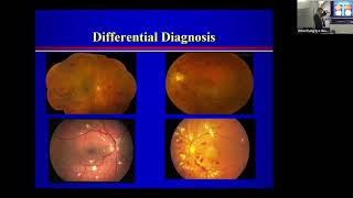 Lecture: Retinal Vein Occlusion: Dr David Miller