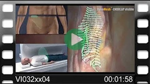 DynaMesh®-ENDOLAP visible - Animation: MRI visible - 3D Implant Remodelling