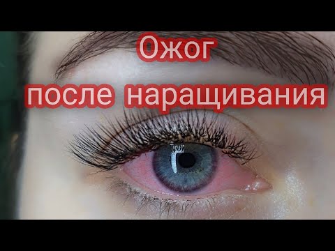 Красные глаза после наращивания ресниц [ожог клеем] - что делать, причины, лечение