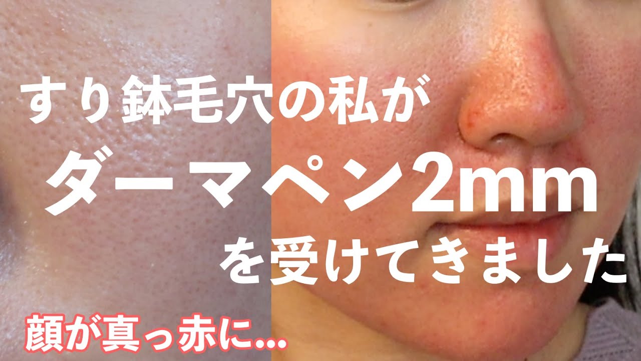 閲覧注意 ダーマペン4の2回目を2mmで受けてきました 値段 施術 経過についてお話しします すり鉢毛穴 毛穴 毛穴の開き いちご鼻 ニキビ跡 角栓 黒ずみ 皮剥け 赤み Dermapen 4 Youtube 閲覧注意 ダーマペン4の2回目を2mmで受けてきました 値段 施術 経過についてお話しします すり鉢毛穴 毛穴 毛穴の開き いちご鼻 ニキビ跡 角栓 黒ずみ 皮剥け 赤み Dermapen 4 Youtube