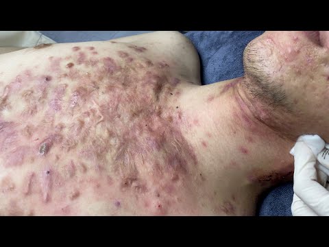 Video: Akne: hvordan håndtere hudormer