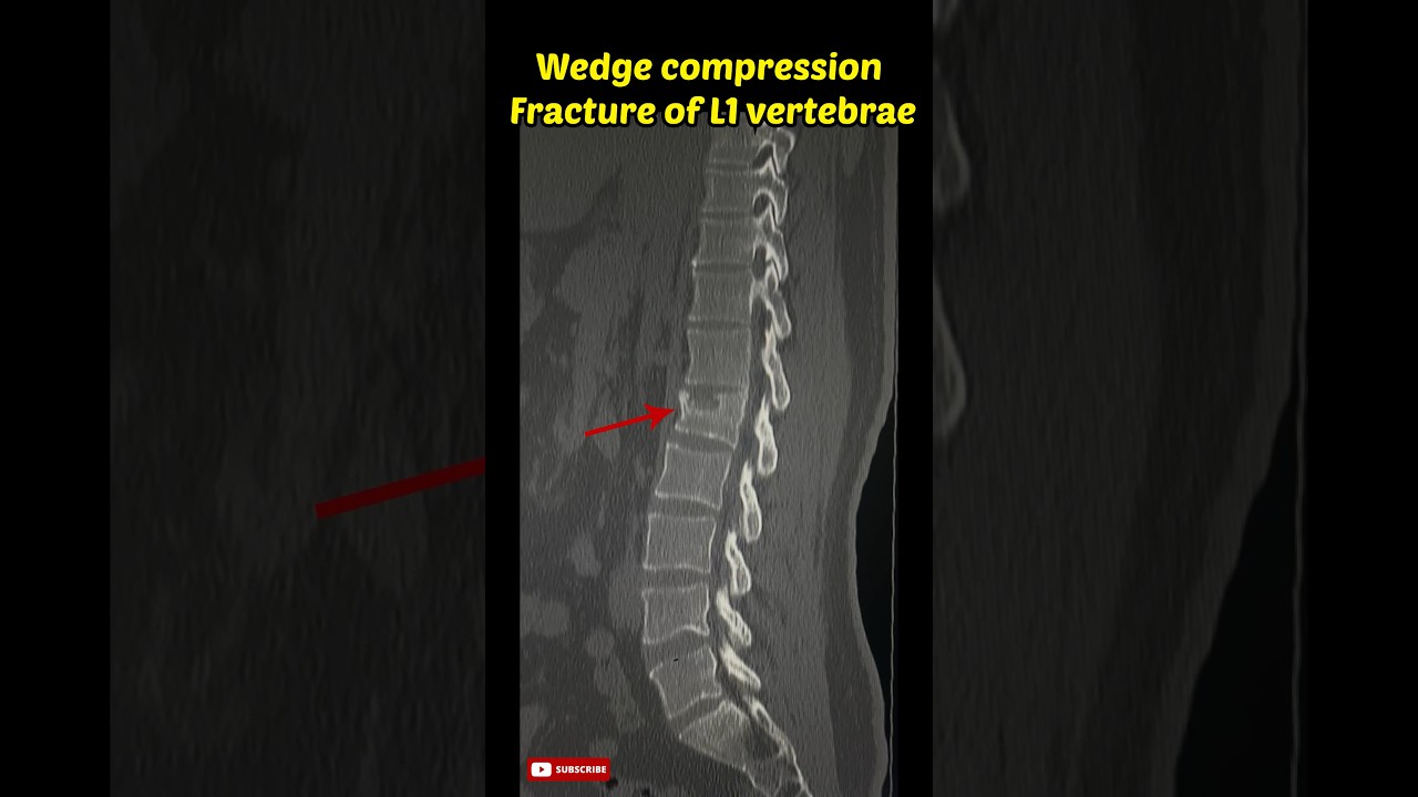 Compression Fracture: How it happens- what is it? 