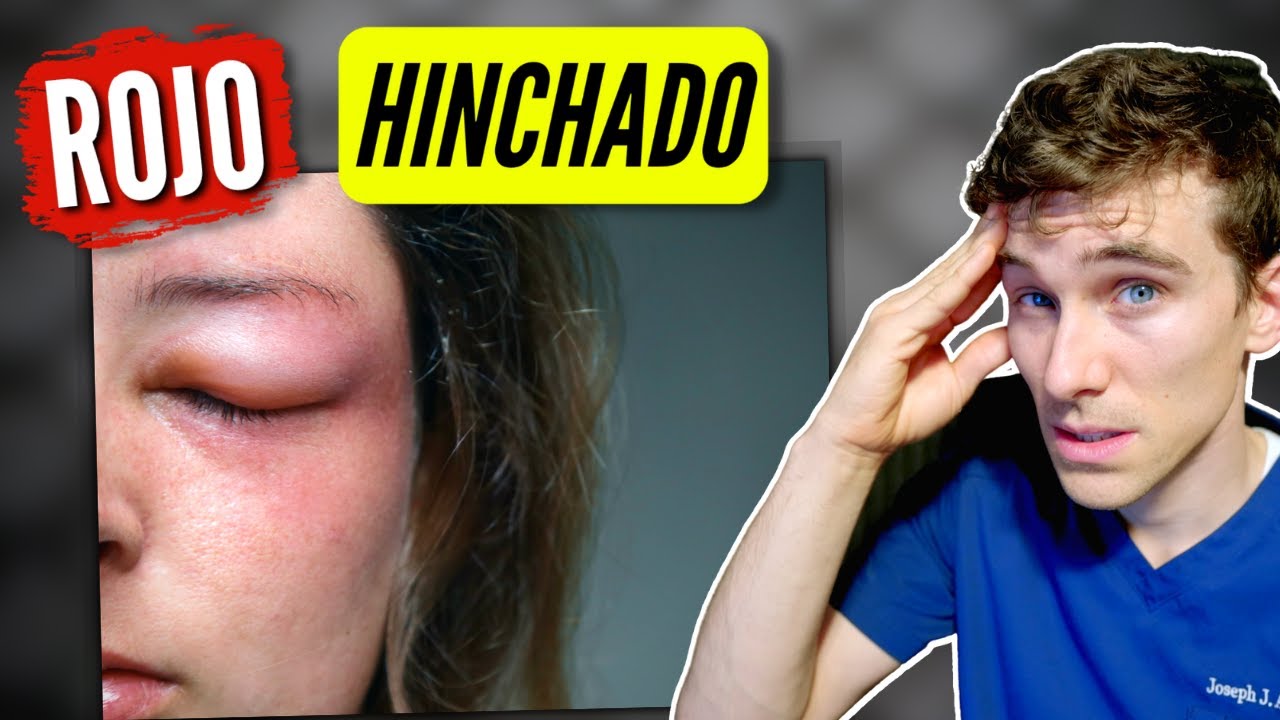 Párpado Hinchado? (Causas y Soluciones) - YouTube