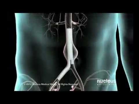 عملية أصلاح تمدد شريان الاورطى البطني بإستخدام القسطرة