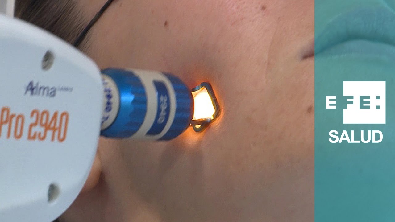 El acne se cura con laser El acne se cura con laser