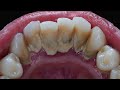 25yo. Male. Calculus Tartar Scaling | Dentist | Dokter Gigi Tri Putra