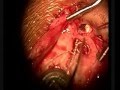 Cochlear Implant - Live Surgery - Implant Surgeon(Aud.Tewfiq Siliman Herini - Erbil-Kurdistan)) tewfiqsiliman@yahoo.com 009647504485973