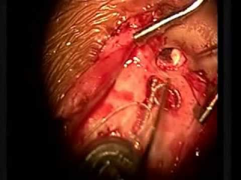 Cochlear Implant - Live Surgery - Implant Surgeon