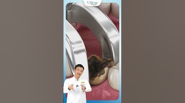 Nhổ Răng Sâu | Bác Sĩ Yên