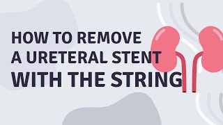 How to remove a ureteral stent on a string