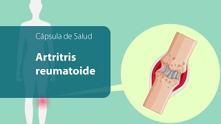 Artritis  reumatoide, una enfermedad autoinmune