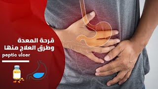 الوصفة الطبية || قرحة المعدة | أنواعها وأسبابها وأعراضها وعلاجها | Peptic ulcer