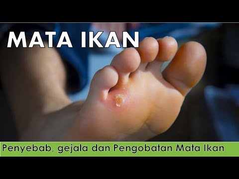 Mata Ikan - Penyebab, gejala dan pengobatannya