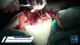 Serdar Nasır MD. / Plastic Surgery - Female to Male Transgender Surgery -  YouTube