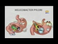 Helicobacter pylori: Sintomas y tratamiento