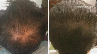 Do LED devices help regrow thinning hair?