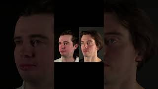 How We Helped a Future Model Achieve His Perfect Face? #rhinoplasty #cosmeticsurgery