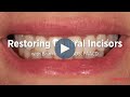 Restoring Central Incisors with Composite with Brian LeSage, DDS, FAACD