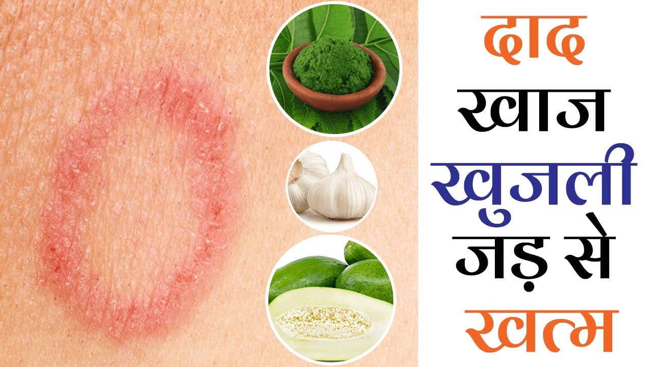 दाद खाज खुजली को जड़ से मिटाने के उपाए // daad khaj khujli ka ilaj