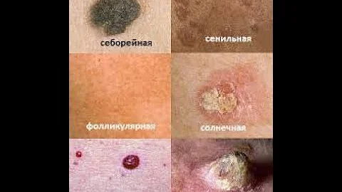 Убрать кератомы: дешёвые аптечные средства.