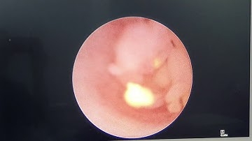 Tại sao sỏi niệu quản để lâu ngày gây hỏng thận, TTƯT.TS.BS. Dương Văn Trung☎️0913534343