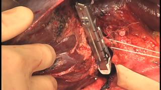 Liver Cancer: Hepatectomy with Radiofrequency Resection Video - Brigham and Women's Hospital