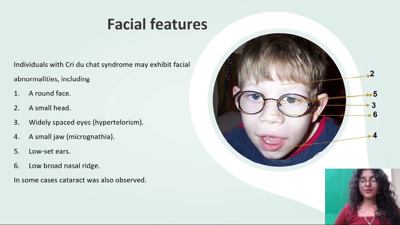 Cri du chat- Genetic Syndrome