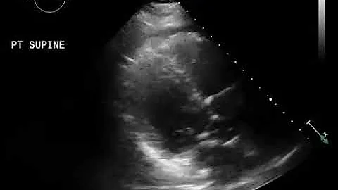Initial echocardiogram demonstrating normal left v...