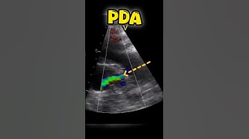 Patent Ductus arteriosus #pda #echocardiogram #heart #heartdisease