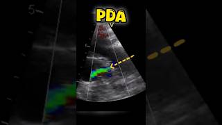 Patent Ductus arteriosus #pda #echocardiogram #heart #heartdisease