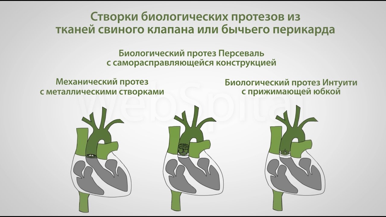 Замена аортального клапана