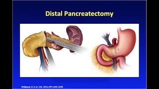 MDCT of Pancreatic Surgery: Normal Post-Op vs. Complications Part 1 screenshot 5