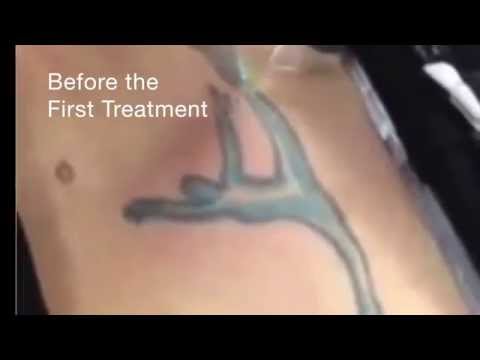 Tramp Stamp Tattoo Removal at Dr. Tattoff Orange County