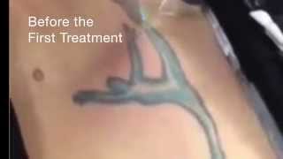 Tramp Stamp Tattoo Removal at Dr. Tattoff Orange County