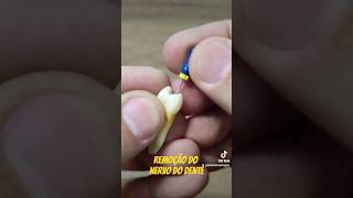 REMOÇÃO DO NERVO DO DENTE  durante tratamento de canal #tratamentodecanal #endodoncia #canal