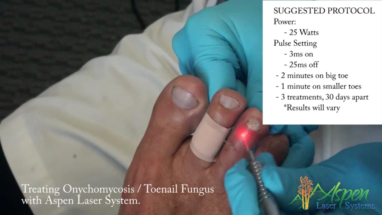 Laser Treatment of Toenail Fungus YouTube