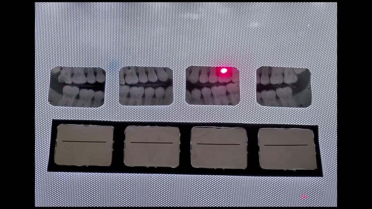 How to Mount Bitewing Radiographs YouTube