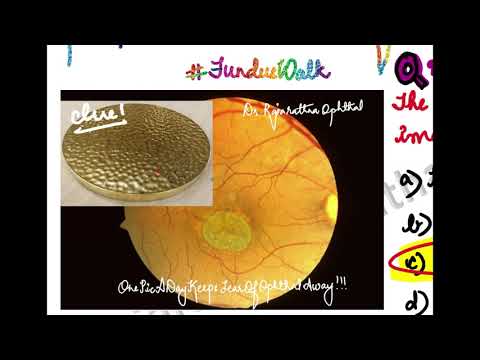 Fundus Walk with Dr.Rajarathna -   Stargardt&rsquo;s disease