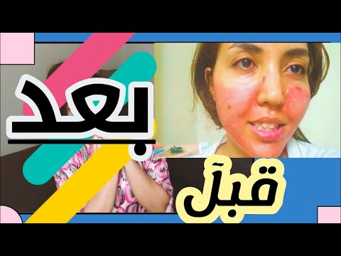 شكلي بعد اول جلسة ليا ديرما بن