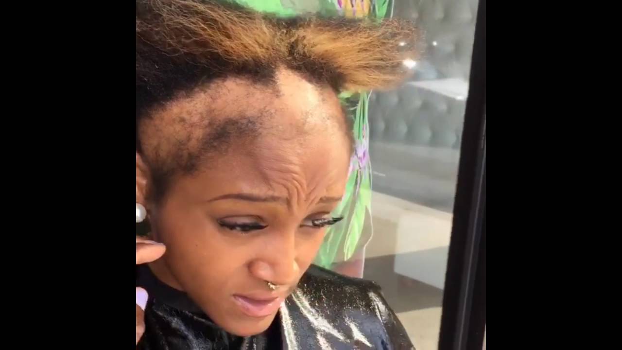 girl suffering from severe hairloss due to braids, sew-ins quick weaves