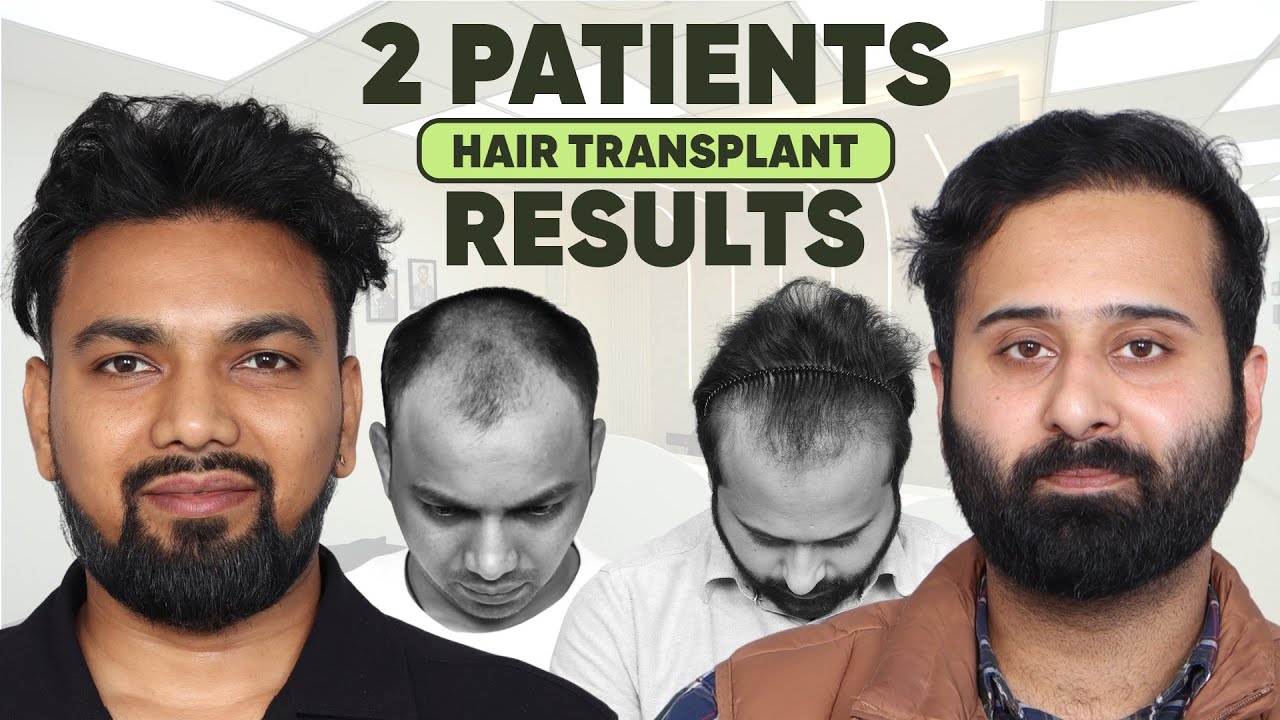 Hair Transplant in Pune (HX-AJKQ) | Best Results & Cost of Hair Transplant in Pune