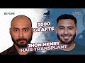 Captivating transformation 3000 grafts hair transplant before and after  stunning 12month results