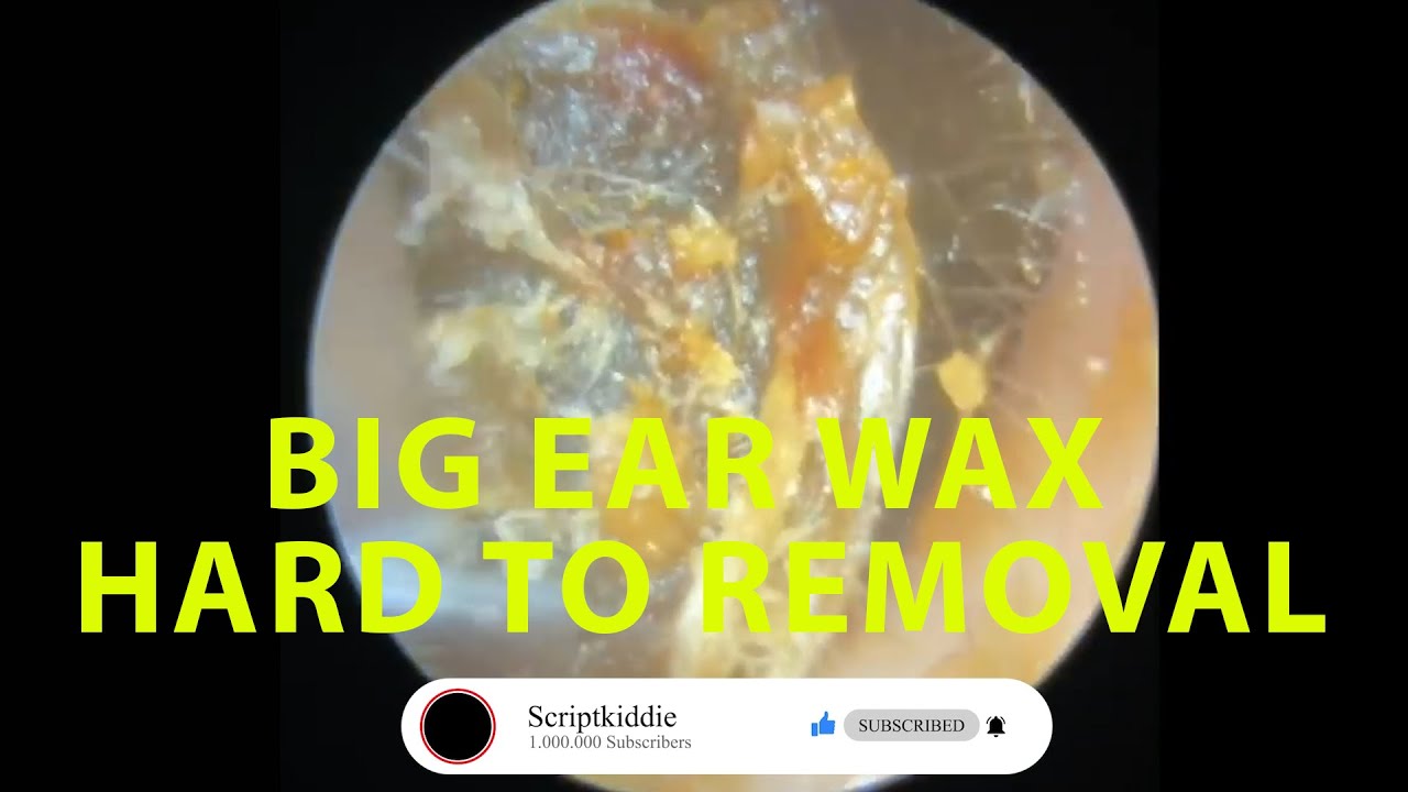 BIG EAR WAX HARD TO REMOVAL !! YouTube